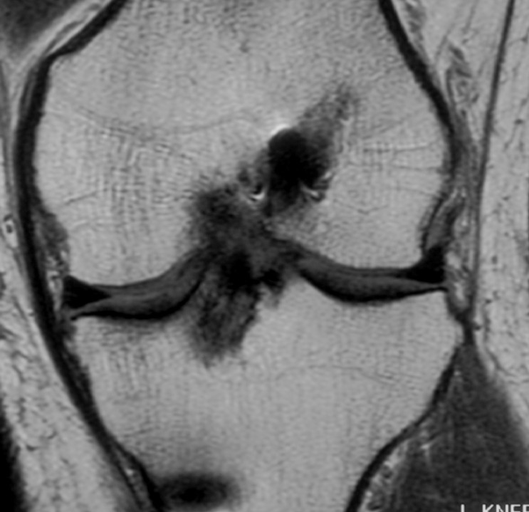 ACL Graft Rupture Coronal MRI